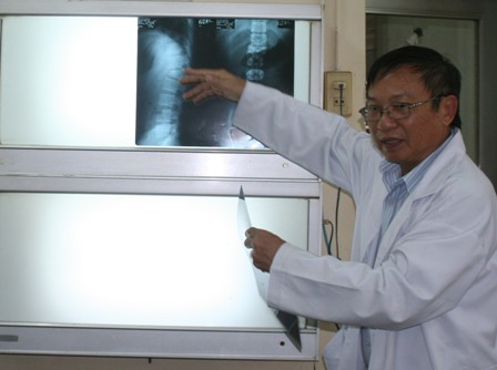 Bao ho lao dong Quang Trung - Gãy, vỡ đốt sống khiến nạn nhân có thể bị liệt